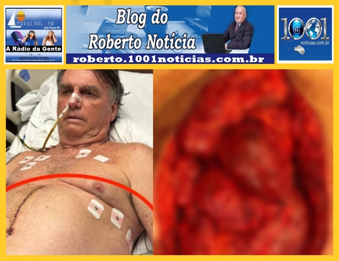 Bolsonaro que teve alta neste domingo choca ao divulgar imagem do prprio intestino antes de cirurgia